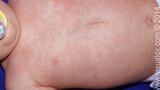 roseola