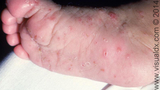 scabies