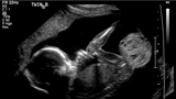 Ultrasound of a fetal sacrococcygeal teratoma