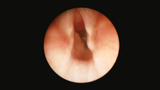 subglottic cysts