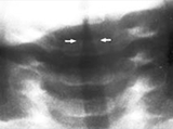 subglottic narrowing