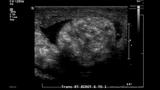 testis mass on xray