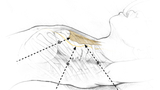 thorascopic thymectomy illustration