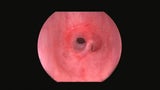 endoscopic view of tracheal stenosis