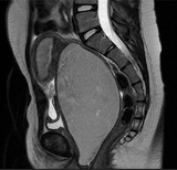 Transverse Vaginal Septum Cause of Urinary Retention Ultrasound