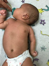 Newborn male with a left upper trunk brachial plexus birth injury