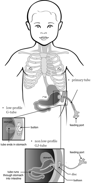 Primary feeding tube conversion