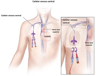 Catéter venoso central tunelizado
