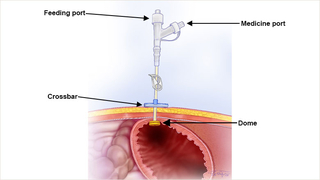 Interventional Radiology placed G tube in the stomach