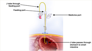 Interventional Radiology placed G tube with J tube threaded through