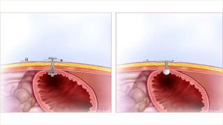 Two examples of low-profile, non-balloon button G tubes in the stomach