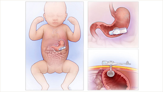 Low-profile balloon G tube in the stomach