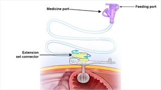 Low-profile balloon G tube with right angle extension set attached for feeds.