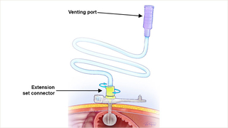 G tube with straight extension set attached for venting