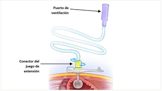 Sonda G con juego de extensión directo conectado para la ventilación