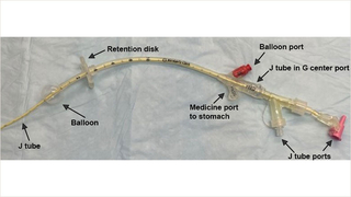 GJ tube with a balloon G tube and a J tube threaded through.