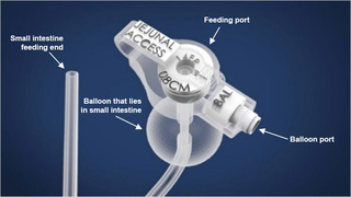 Low-profile balloon J tube