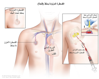 تعليمات المريض: القابل للغرس المدخل الوريدي