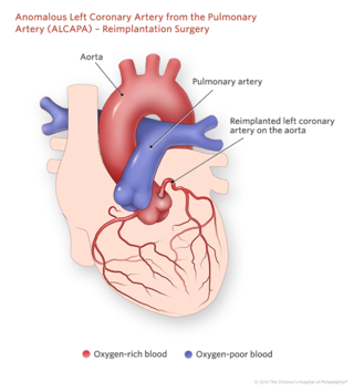 Anomalous Left Coronary Artery From the Pulmonary Artery Reimplantation Surgery Illustration