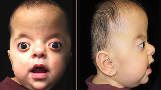 Baby with Apert Syndrome portrait front and side profile