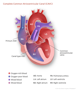 Complete common atrioventricular canal (CAVC) defect illustration