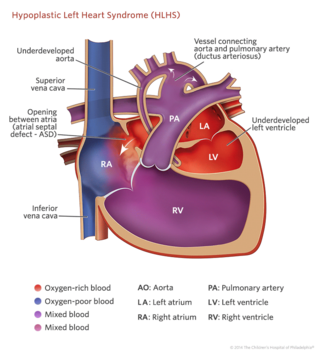 hypoplastic left heart syndrome (HLHS) illustration