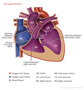 tricuspid atresia heart illustration