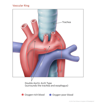 vascular ring heart illustration