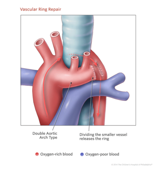 vascular ring repair illustration