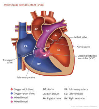 ventricular septal defect heart illustration