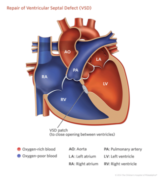 ventricular septal defect repair illustration