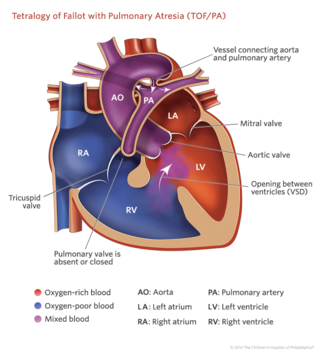 Tetralogy of fallot with pulmonary atresia illustration.