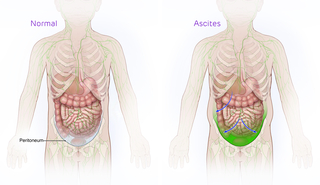 Ascites medical illustration