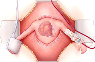 arley procedure illustration. 