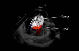 Arley fetal echocardiogram.