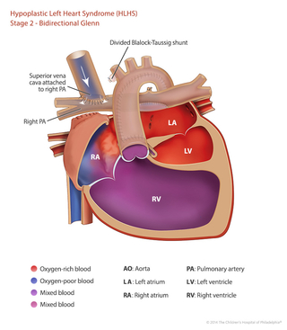 HLHS medical illustration of the staged heart repair Glenn procedure