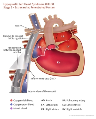 HLHS medical illustration of the staged heart repair Fontan procedure