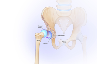 Dislocated hip illustration