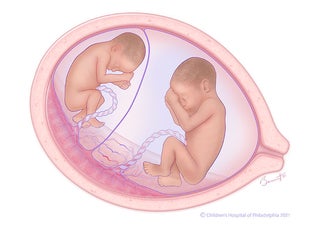 Twin-to-twin transfusion syndrome (TTTS) stage 1 illustration