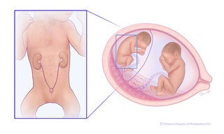 Twin-to-twin transfusion syndrome (TTTS) stage 2 illustration