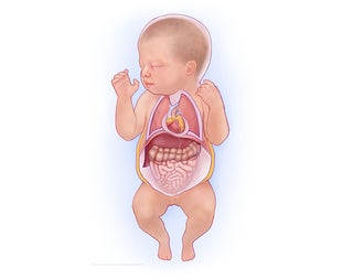 Twin-to-twin transfusion syndrome (TTTS) stage 4 with hydrops illustration