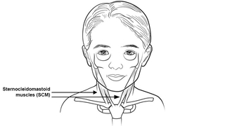 Congenital Muscular Torticollis - Sternocleidomastoid muscles (SCM)