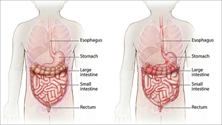 GI tract normal vs. Crohn's Disease cropped illustration