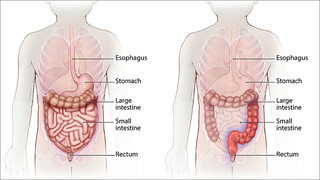 Normal GI tract vs. ulcerative colitis in children illustration