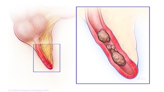 Illustration of appendicitis composition