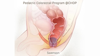 Illustration of intestine after pull-through procedure with Swenson technique