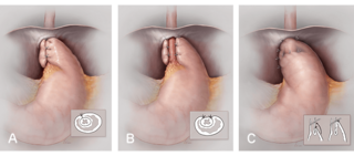 Illustrations of types of fundoplication surgeries