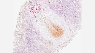 fetal neonatal lung disease