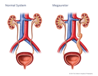 Megaureter Illustration