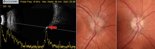 Optic Nerve Head Elevation Case Study